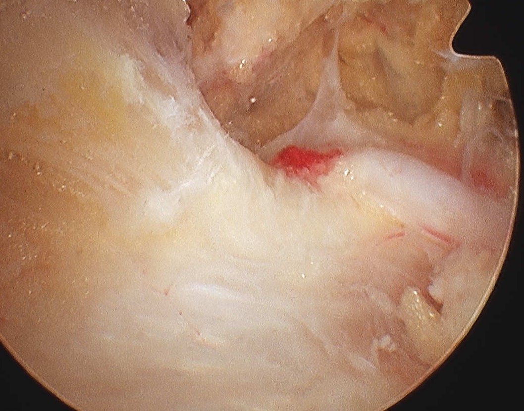 Conoid Ligament  SSA over THL